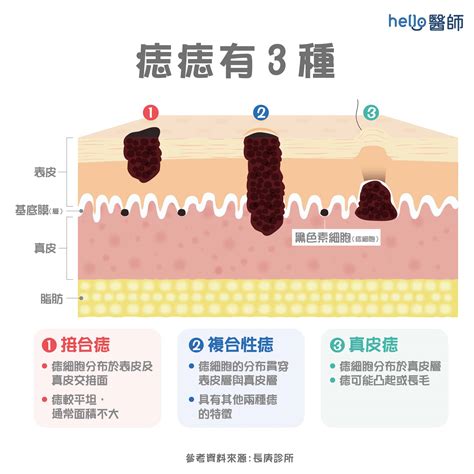 痣 形成原因|痣變大、痣多或長毛會變皮膚癌？認識痣的形成與原因